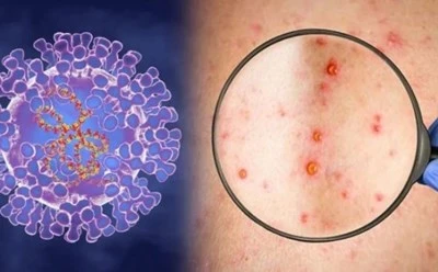 Video: Xuất hiện nhiều ca mắc đậu mùa khỉ ở Châu Á