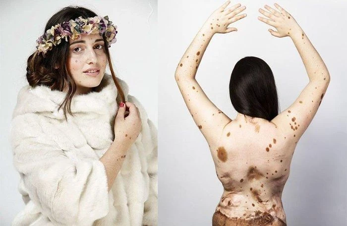 Cô gái có 1.200 nốt ruồi vẫn tự tin theo đuổi nghề người mẫu