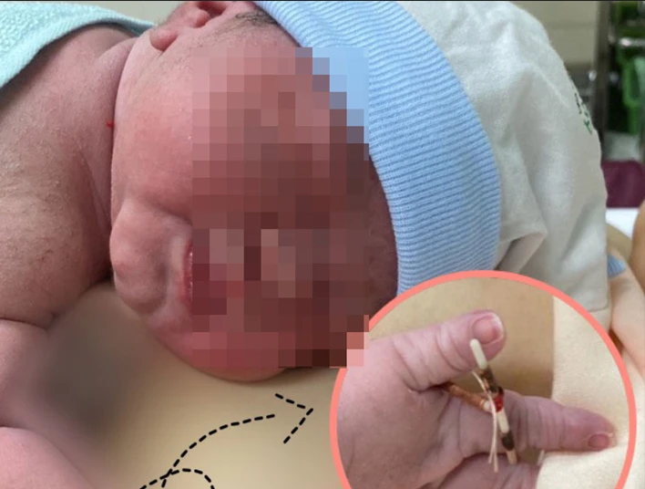 Hy hữu: Bé gái chào đời cùng... vòng tránh thai của mẹ