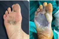 Phát hiện ung thư từ vết đen ở bàn chân suốt 15 năm