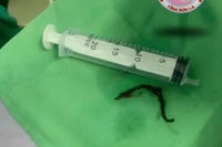 Cấp cứu thành công bệnh nhân 48 tuổi mắc dị vật thực quản dài 12 cm