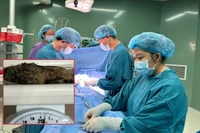 Bé gái 6 tuổi ở Quảng Ngãi mang búi tóc 0,5 kg trong dạ dày