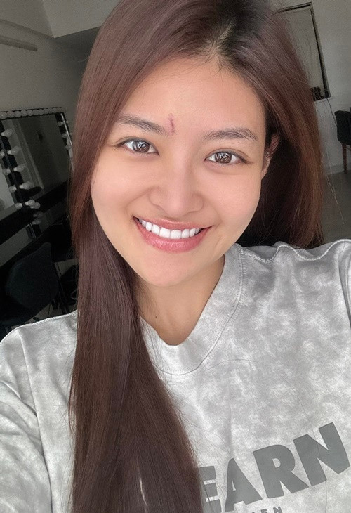 Cách đây không lâu, nữ diễn viên bị thương ở trán, phải khâu 4 mũi. Thùy Anh chia sẻ trên Znews, bạn diễn vô tình đập điện thoại vào trán cô trong một cảnh quay phim "Bước ngoặt" ở Phú Yên.