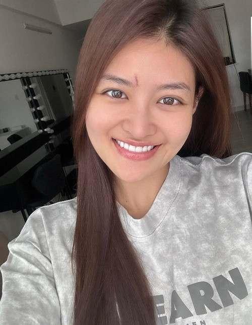 Thùy Anh chia sẻ trên Znews, bạn diễn vô tình đập điện thoại vào trán cô trong một cảnh quay phim Bước ngoặt ở Phú Yên. Thùy Anh trở về TP.HCM để khâu vết thương. Một tuần tới, khi được cắt chỉ, Thùy Anh sẽ tiếp tục quay phim. Ảnh: FB Thùy Anh.