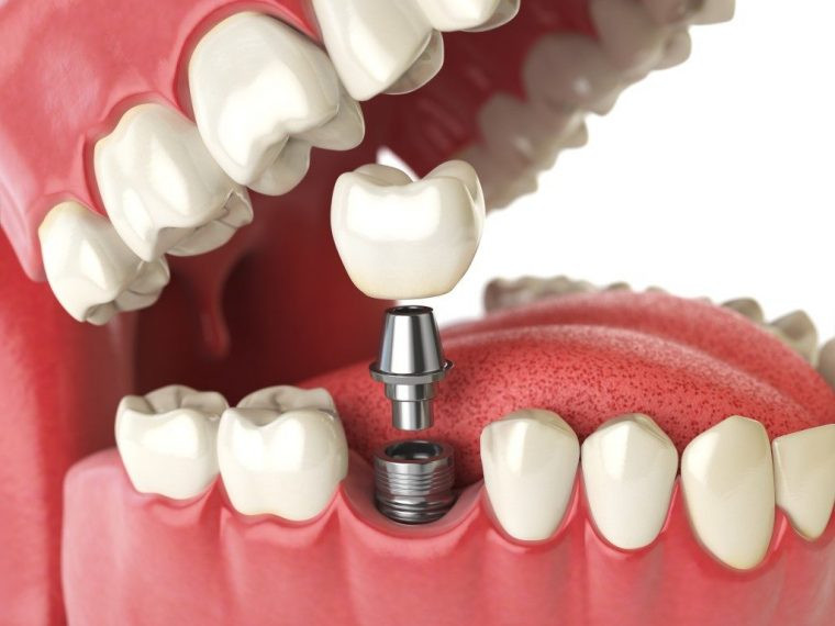 Phương pháp trồng răng implant có tác dụng phục hồi lại răng bị mất hoàn toàn. Ảnh: nhakhoanacera.