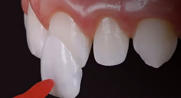 Dán răng sứ là phương pháp an toàn, nhanh chóng giúp khắc phục hiệu quả mọi khiếm khuyết của răng nên được khá nhiều người lựa chọn hiện nay bên cạnh phương pháp bọc răng sứ và niềng răng. Ảnh: nhakhoamientay.