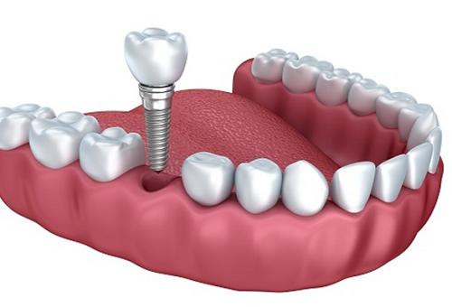 Để trồng răng implant đúng kỹ thuật, ngoài giỏi nghề, còn đòi hỏi sự khéo léo, cẩn thận của bác sĩ. Ảnh: mediacdn.