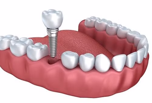 Để trồng răng implant đúng kỹ thuật, ngoài giỏi nghề, còn đòi hỏi sự khéo léo, cẩn thận của bác sĩ. Ảnh: mediacdn.