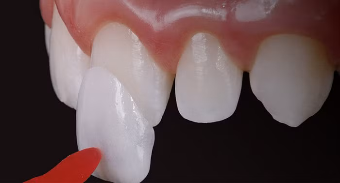 So với những phương pháp thẩm mỹ nha khoa khác, dán răng sứ Veneer có nhiều ưu điểm như không gây ê buốt khi ăn nhai, không tác động đến mô răng thật và giữ được màu răng trắng sáng trong thời gian dài. Ảnh: nhakhoakim.