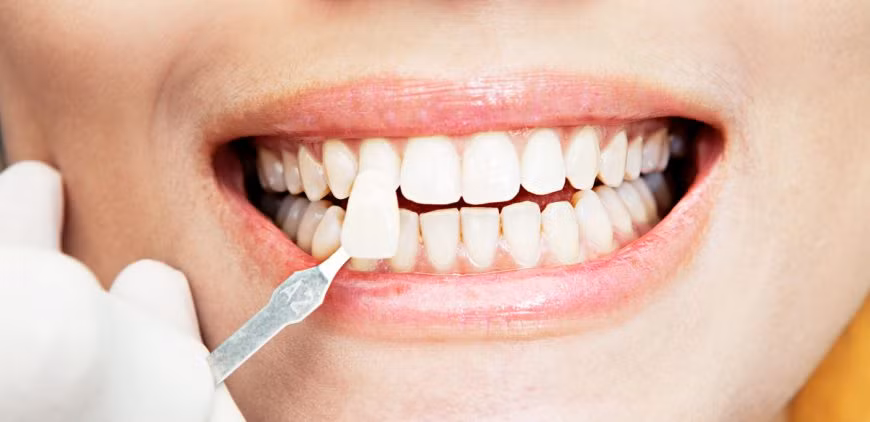 Bạn nên sử dụng loại bàn chải có lông tơ mịn màng. Ảnh: wollatondentalcare.