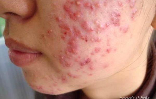 Hoc ngay 3 cach tri mun boc cuc ki hieu nghiem tai nha