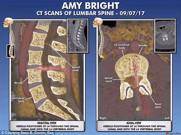 Dị vật dài 3cm nằm trong cột sống của bệnh nhân