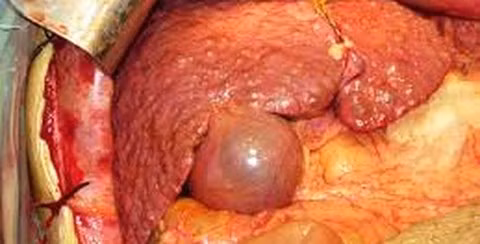 Đa số bệnh nhân đều phát hiện ở giai đoạn muộn