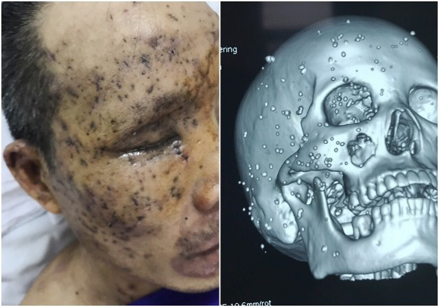 Nạn nhân N bị các mảnh vụn kim loại găm vào vùng mặt - Ảnh: Hà Trang.