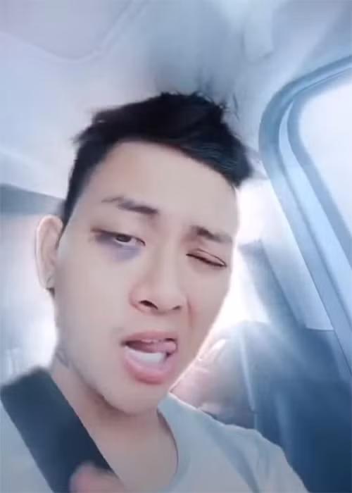 Quản lý của Hoài Lâm khẳng định vết bầm là do trong lúc đá bóng, Hoài Lâm vô tình bay lên và va trúng tay người bạn.