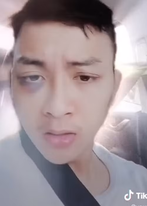 Cách đây ít ngày, Hoài Lâm lộ clip ngồi trên xe hơi và lắc lư theo nền nhạc. Đáng chú ý, một bên mắt của nam ca sĩ bầm tím.