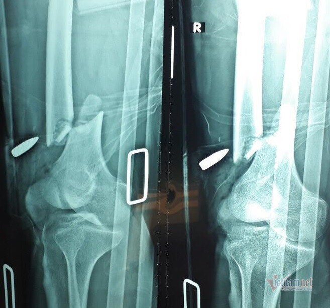 Vu no sung o Cu Chi: Bac si gap dau dan khoi dui nan nhan bi thuong-Hinh-2