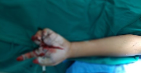 No phao, be trai nhap vien voi ban tay chi con 1 ngon