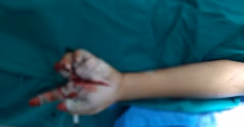 No phao, be trai nhap vien voi ban tay chi con 1 ngon