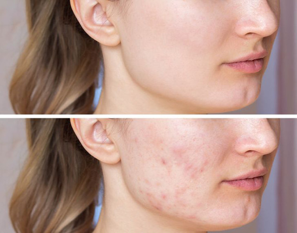 Da trở nên nhạy cảm hơn. Da mặt của mỗi người rất mỏng và có một số mao mạch nhỏ. Khi rửa mặt bằng nước nóng, nó làm mất đi lớp dầu tự nhiên khiến da bạn bị khô, nứt nẻ và ngày càng nhạy cảm hơn. Bạn sẽ nhận thấy điều này một cách dễ dàng khi rửa mặt nước ấm từ vòi hoa sen mùa đông.