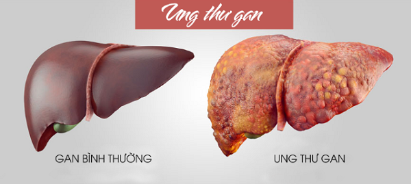 Tại bệnh viện, ban đầu bác sĩ cho rằng Hiểu Hạ có vấn đề về huyết áp dẫn đến ngất xỉu. Tuy nhiên, sau khi thực hiện loạt kiểm tra thì bác sĩ phát hiện các chỉ số chức năng gan bất thường, chẩn đoán mắc ung thư gan giai đoạn cuối.