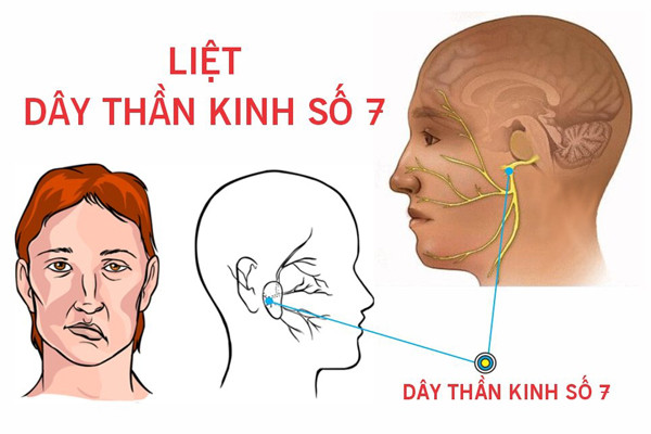 Liệt dây thần kinh mặt bắt nguồn từ 2 nhóm nguyên nhân. Nguyên nhân nguyên phát do mạch máu nuôi của dây thần kinh bị co thắt gây thiếu máu cục bộ và phù, chèn ép lên dây thần kinh. Tình trạng liệt thường là tự phát có liên quan đến yếu tố lạnh.