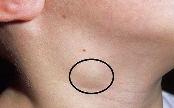 Thực tế, nhiều người phát hiện ung thư khi vô tình tiếp xúc với khối u trên cổ, nách, ngực, bẹn... Ở giai đoạn đầu, chúng không gây đau đớn nên hay bị bỏ qua. Điều này rất bất lợi bởi điều trị sớm có ảnh hưởng lớn đến khả năng chiến thắng bệnh tật.