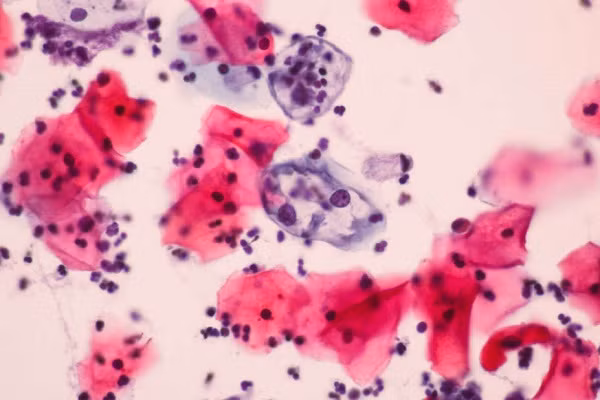 Bị đau chân phát hiện ung thư tử cung, 4 dấu hiệu nguy hiểm ai cũng coi thường - Hình 2 Bi dau chan phat hien ung thu tu cung, 4 dau hieu nguy hiem ai cung coi thuong-Hinh-2