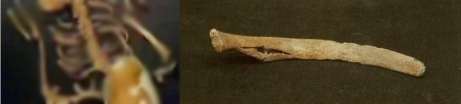 Cô gái này từng phạm một tội nghiêm trọng liên quan đến quy tắc kết hôn. Do vậy, cô bị trừng phạt bằng việc bị đánh gãy xương sườn. Sau đó, người trong bộ tộc sẽ dùng 18 dụng cụ sắc nhọn được làm từ xương động vật để đóng vào cơ thể cô gái. Cuối cùng, hình phạt này khiến cô tử vong. Nếu điều này là chính xác thì cô gái trên đã có cái chết đầy đau đớn sau khi nhận hình phạt nặng nề.