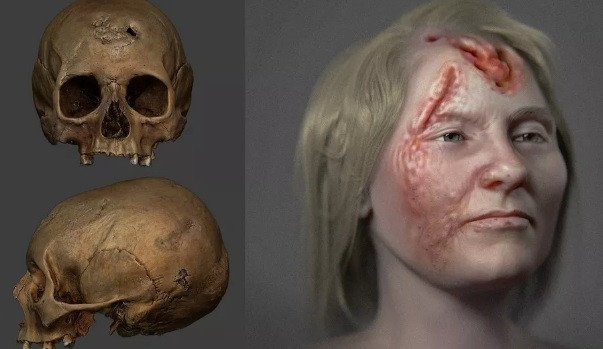 Trong cuộc khai quật tại một nghĩa trang ở tu viện Skriðuklaustur, Iceland từ năm 2002 - 2012, các chuyên gia tìm thấy một hộp sọ. Hiện nó được lưu giữ tại Bảo tàng Quốc gia Iceland. Qua các nghiên cứu, hộp sọ thuộc về một phụ nữ 500 tuổi chết vì bệnh giang mai.