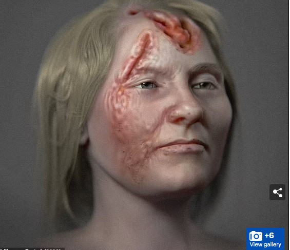 Các chuyên gia cho hay người phụ nữ này qua đời khi khoảng 25 - 30 tuổi. Tình trạng hộp sọ cho thấy người này có nhiều tổn thương nghiêm trọng do căn bệnh giang mai gây ra.