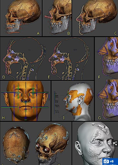 Kỳ dị hơn, một số thầy thuốc thực hiện liệu pháp trích máu từ cơ thể người bệnh ra ngoài với niềm tin rằng mầm bệnh sẽ thoát ra ngoài theo.