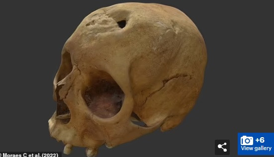 Tuy nhiên, hiện các chuyên gia chưa thể xác định nguyên nhân dẫn đến cái chết của người phụ nữ có liên quan đến căn bệnh giang mai hay không.