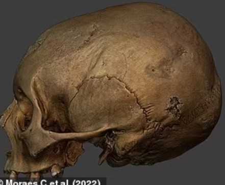 Tuy nhiên, những phương pháp điều trị này không giúp tình trạng sức khỏe của người mắc bệnh giang mai có chuyển biến tốt hơn. Thay vào đó, người bệnh thường bị biến dạng gương mặt do mắc phải căn bệnh nguy hiểm này.