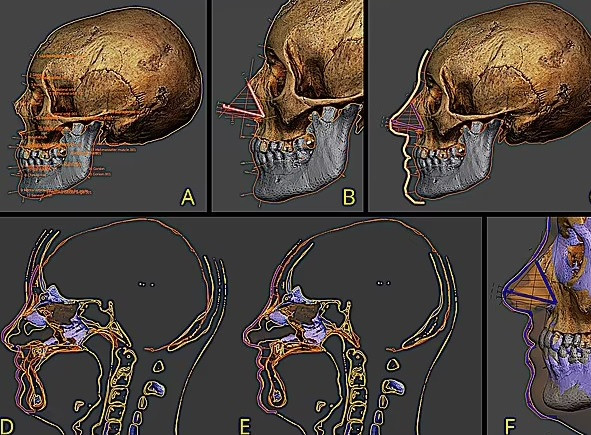 Vào thời điểm người phụ nữ trên sống, các phương pháp điều trị bệnh giang mai phổ biến ở châu Âu chủ yếu sử dụng vỏ cây Guaiacum sanctum - một loại thảo dược có tác dụng chống viêm.