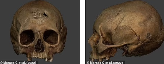 Mới đây, một chuyên gia đã công bố hình ảnh phục dựng gương mặt của người phụ nữ trên. Hình ảnh cho thấy người này khi còn sống có nhiều vết loét nghiêm trọng ở trên mặt.