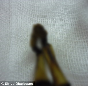 Tiếp đến, nhóm nghiên cứu tìm thấy bằng chứng chứng minh xác ướp Ata thuộc về một bé gái sơ sinh có nhiều đột biến gene gắn liền với chứng lùn, vẹo cột sống và nhiều bất thường ở hệ cơ và xương.