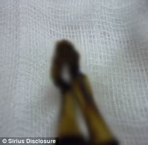 Tiếp đến, nhóm nghiên cứu tìm thấy bằng chứng chứng minh xác ướp Ata thuộc về một bé gái sơ sinh có nhiều đột biến gene gắn liền với chứng lùn, vẹo cột sống và nhiều bất thường ở hệ cơ và xương.