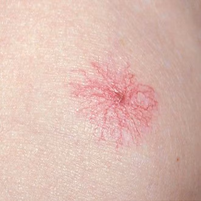 6 dau hieu tien ung thu gan ban nen de y, dung de cai chet den gan-Hinh-4