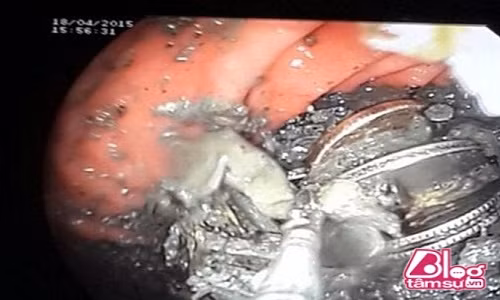 Dau bung quan quai, chet lang thay thu ghe ron nay trong da day-Hinh-2