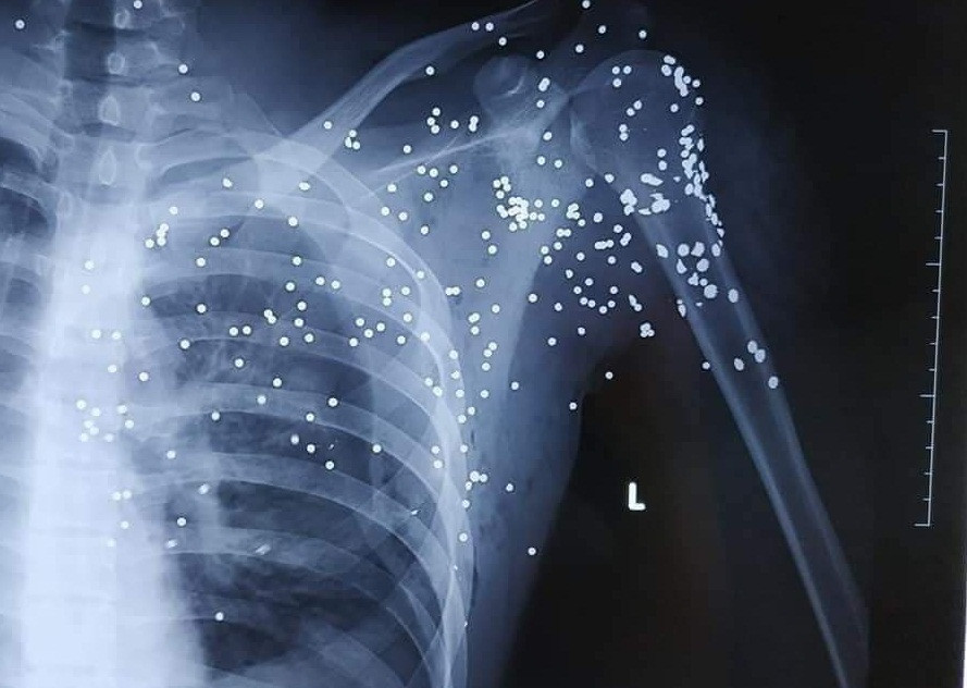 Thai Binh: Ke la mat no sung hoa cai vao 1 thanh nien tai tram BOT