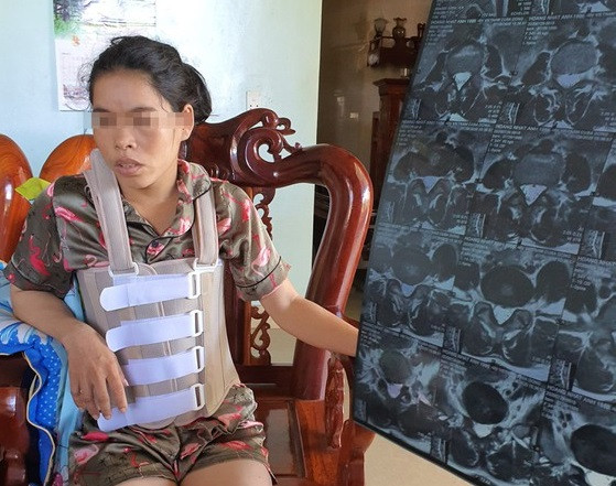  Một phụ nữ bị hành hung dã man suốt 11 năm. Ngày 7/11, Công an huyện Bố Trạch (Quảng Bình) đã ra quyết định khởi tố vụ án cố ý gây thương tích xảy ra tại xã Tây Trạch, huyện Bố Trạch. Đồng thời, khởi tố bị can Nguyễn Văn Dũng (SN 1975) về tội cố ý gây thương tích. Thời gian qua, bà Hoàng Nhật Ánh (SN 1986) đã tố bị chồng hành hung suốt 11 năm khi hai người ở giữa rừng cao su, vắng người. Viện Pháp y Trung ương kết luận bà Ánh bị thương tật vĩnh viễn 42% do ngoại lực tác động (đánh đập). Ảnh: SGGP 