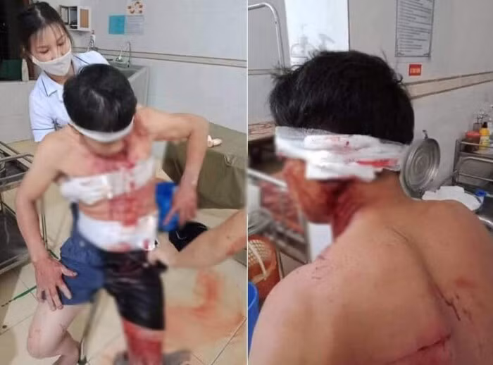  Nhóm đối tượng xông vào nhà đánh người trọng thương: Ngày 22/11, Chủ tịch UBND xã Hương Trạch, huyện Hương Khê (Hà Tĩnh) cho biết, trên địa bàn xã vừa xảy ra vụ mâu thuẫn khiến một người đàn ông bị đánh trọng thương. Cụ thể, vào khoảng hơn 20h ngày 20/11, tại nhà anh Nguyễn Văn Hùng (SN 1973, trú tại xóm Tân Trung, xã Hương Trạch, huyện Hương Khê), do mâu thuẫn trước đó một nhóm đối tượng đã xông vào nhà. Tại đây, các đối tượng đã dùng dao chém nhiều nhát vào người và đầu anh Hùng.