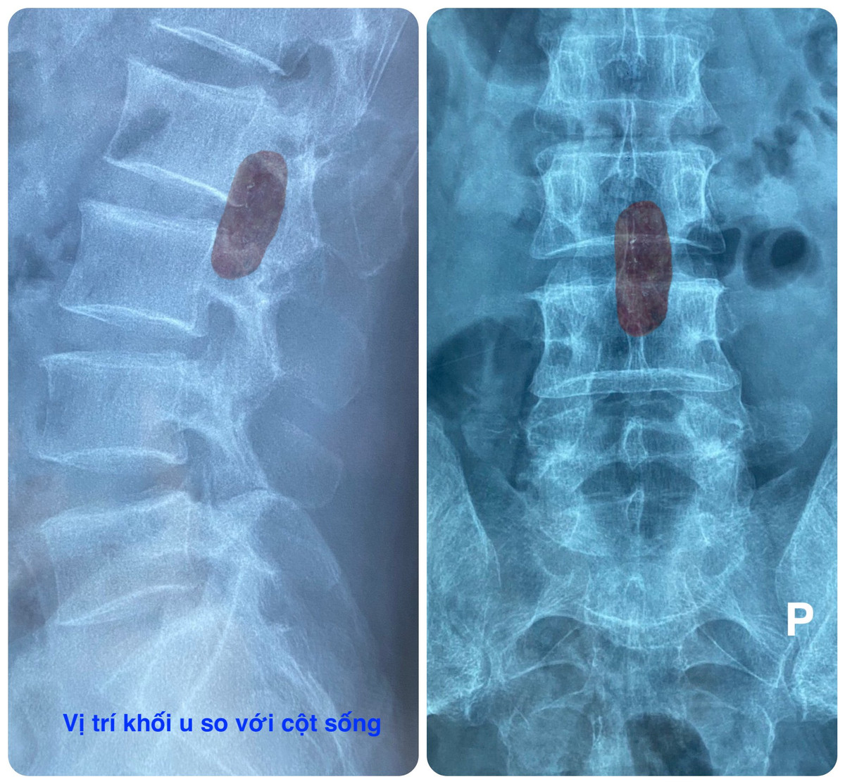 Tưởng đau lưng đơn giản, người đàn ông không ngờ có khối u lớn Tuong dau lung don gian, nguoi dan ong khong ngo co khoi u lon