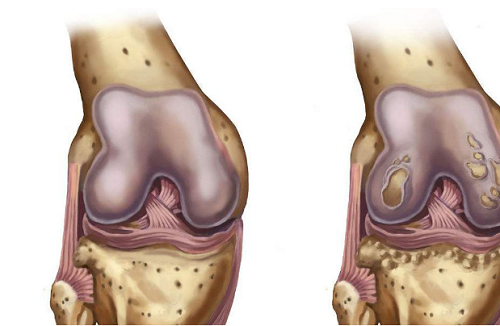 Mệt mỏi quá mức. Mệt mỏi, thiếu ngủ hoặc nghỉ ngơi quá nhiều đều có thể gây ra sự tích tụ cục bộ các chất chuyển hóa có tính axit, gây co thắt cơ. Những hoạt động như đi đường dài, leo núi, đi bộ hoặc tập luyện lâu khiến chi dưới mệt mỏi quá mức, axit lactic tích tụ, cơ bắp chân dễ bị mỏi nhất. Mệt mỏi đến mức nhất định, cơ thể sẽ bị chuột rút.