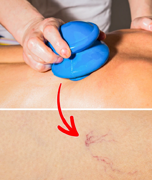 Giác hơi. Nhiều beauty blogger thổi phồng hiệu quả của giác hơi, cho rằng nó có thể cải thiện nếp nhăn trên mặt, ngăn ngừa da chảy xệ và làm chậm quá trình lão hóa. Vậy nhưng, phương pháp làm đẹp này không an toàn, đơn giản, phù hợp với mọi đối tượng như quảng cáo.