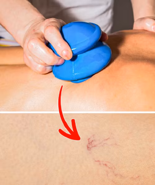 Giác hơi. Nhiều beauty blogger thổi phồng hiệu quả của giác hơi, cho rằng nó có thể cải thiện nếp nhăn trên mặt, ngăn ngừa da chảy xệ và làm chậm quá trình lão hóa. Vậy nhưng, phương pháp làm đẹp này không an toàn, đơn giản, phù hợp với mọi đối tượng như quảng cáo.