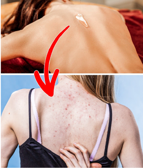 Dưỡng ẩm da bằng dầu dừa. Nhiều beauty bloggers tung hô dầu dừa là sản phẩm dưỡng ẩm tự nhiên, an toàn tuyệt đối cho da. Nghiên cứu chỉ ra, dầu dừa chứa axit lauric, capric, vitamin E và chất béo bão hòa giúp làm mềm, phục hồi hiệu quả làn da thô ráp ở khuỷu tay và gót chân.