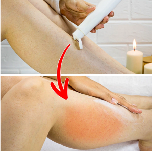 Dùng gel triệt lông. Gel triệt lông được quảng cáo dễ sử dụng, mang lại hiệu quả tương tự như tẩy lông bằng sáp mà không gây đau đớn. Tuy nhiên, gel triệt lông tiềm ẩn nguy cơ chứa hóa chất mạnh, sử dụng lâu dài có thể gây hại da. Trường hợp nhẹ, chúng có thể gây kích ứng, dị ứng. Trường hợp nặng, người dùng có thể bỏng hóa chất.