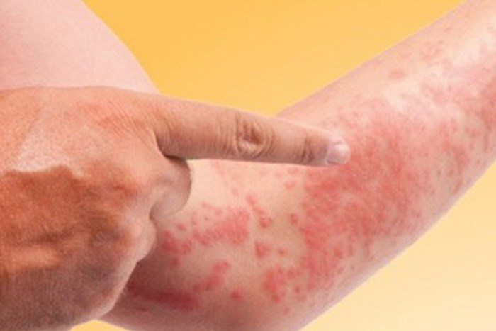 Nhung van de suc khoe nguy hiem thuong gap trong mua dong-Hinh-5